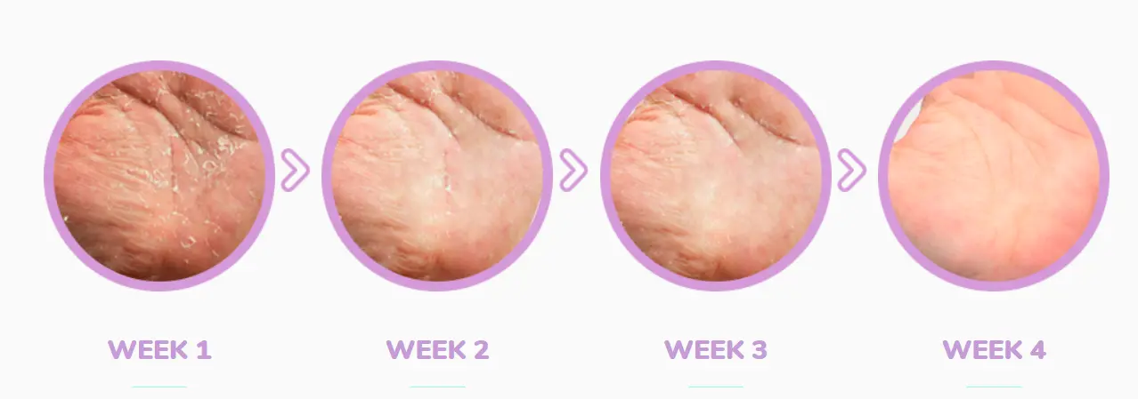 weeks after dr derm